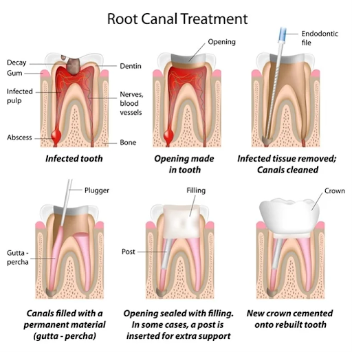 Root-Canal - Newark Family Dental
