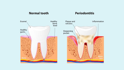 periodontal-maintenance - Newark Family Dental